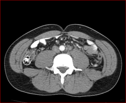 File:Burned-out testicular choriocarcinoma (Radiopaedia 32822-34040 B 16).PNG