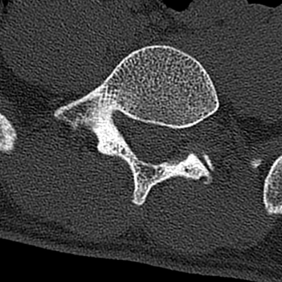 Burst fracture (Radiopaedia 53373-59357 Axial bone window 60).jpg