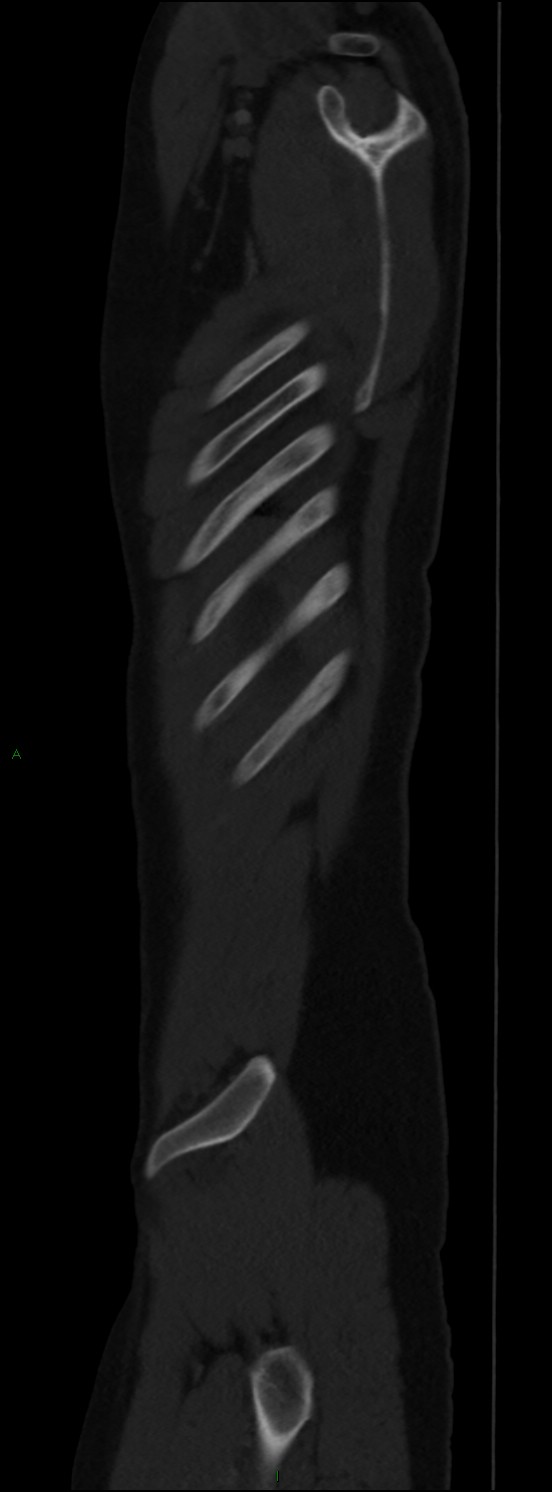 Burst fracture (Radiopaedia 83168-97542 Sagittal bone window 110).jpg