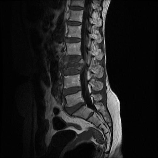 File:Burst fracture - lumbar spine (Radiopaedia 72877-83541 Sagittal T1 6).jpg