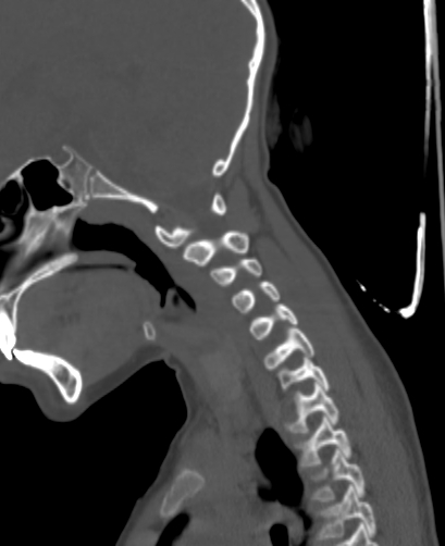 File:Butterfly vertebra (Radiopaedia 77903-90209 Sagittal bone window 26).jpg