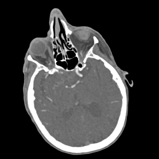 C2 fracture with vertebral artery dissection (Radiopaedia 37378-39200 A 240).png