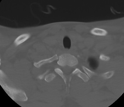 C7 laminar fracture and Klippel-Feil syndrome (Radiopaedia 86710-102850 Axial bone window 67).jpg