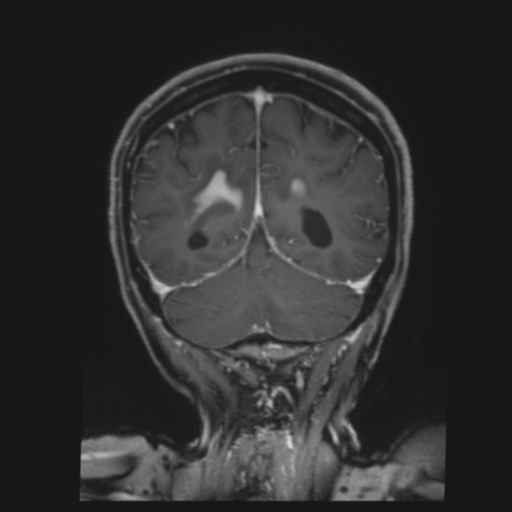 CNS lymphoma with steroid response (Radiopaedia 37980-39921 Coronal T1 C+ 37).png