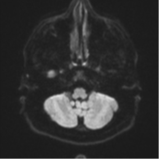 File:CNS vasculitis (Radiopaedia 55715-62263 Axial DWI 34).png