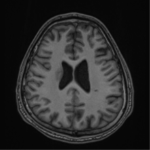 CNS vasculitis (Radiopaedia 55715-62263 Axial T1 56).png