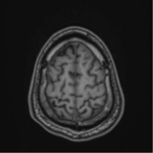 CNS vasculitis (Radiopaedia 55715-62263 Axial T1 88).png