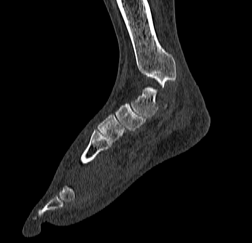 File:Calcaneal fracture - Sanders type 4 (Radiopaedia 90179-107370 Sagittal bone window 37).jpg