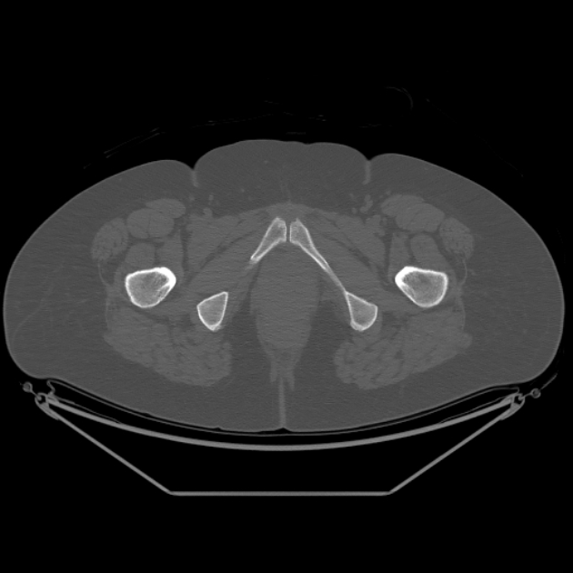 Calcific tendinitis of the gluteus medius muscle (Radiopaedia 66998-76318 Axial bone window 68).jpg