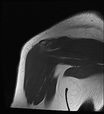 File:Calcific tendinitis of the infraspinatus tendon (Radiopaedia 87256-103537 Coronal T1 19).jpg