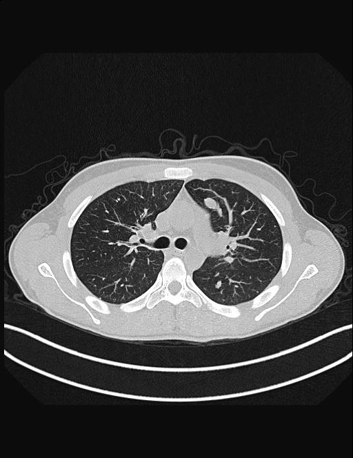 Calcifying pulmonary metastases (Radiopaedia 33359-34396 Axial lung window 23).jpg