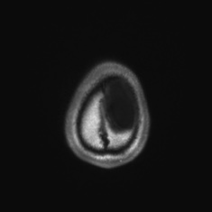 Callosal dysgenesis with interhemispheric cyst (Radiopaedia 53355-59335 Axial T1 152).jpg
