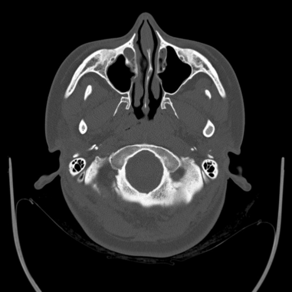 Calvarial osteoma (Radiopaedia 36520-38079 Axial bone window 13).jpg