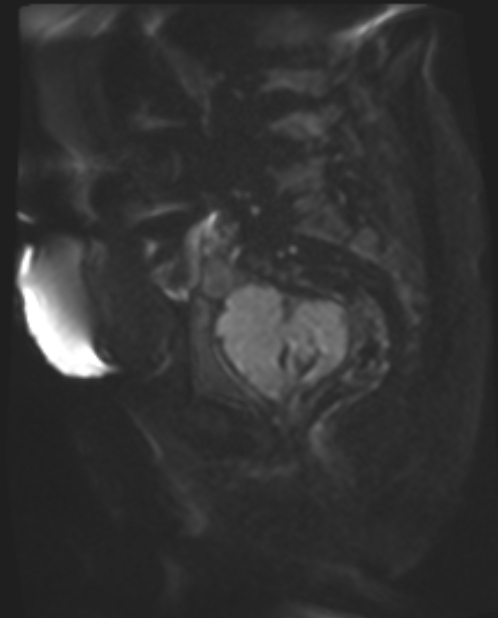 Cancer cervix - stage IIb (Radiopaedia 75411-86615 Sagittal DWI 59).jpg