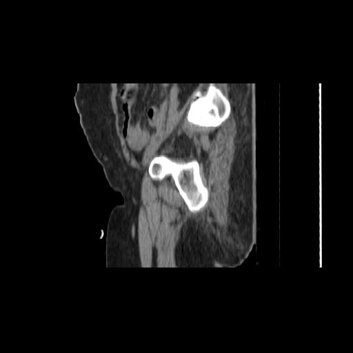 Carcinoma cervix- brachytherapy applicator (Radiopaedia 33135-34173 D 31).jpg