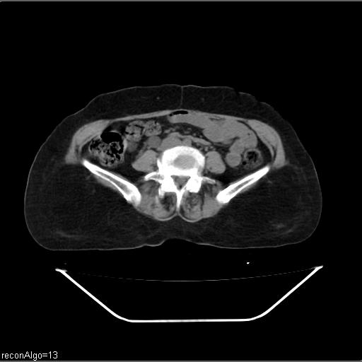 File:Carcinoma cervix- recurrence (Radiopaedia 34702-36137 Axial non-contrast 33).jpg