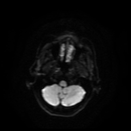 File:Carcinoma ex-pleomorphic adenoma of parotid (Radiopaedia 28383-28627 Ax DWI B-500 GE 59).jpg