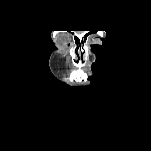 Carcinoma of the maxillary antrum (Radiopaedia 53805-59888 Coronal C+ delayed 11).jpg