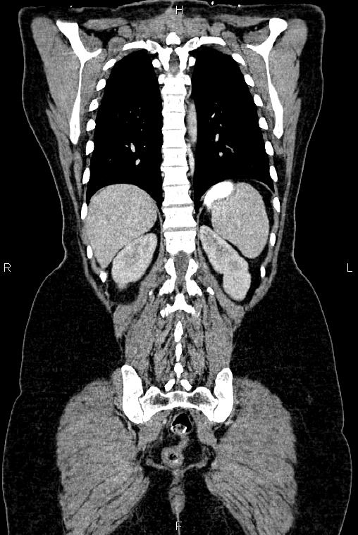 Carcinoma of uterine cervix (Radiopaedia 85861-101700 C 45).jpg