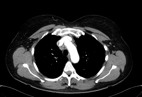 Cardiac sarcoidosis (Radiopaedia 74548-85534 A 22).jpg