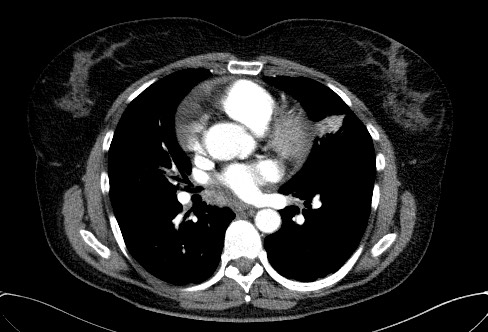 Cardiac sarcoidosis (Radiopaedia 74548-85534 A 44).jpg