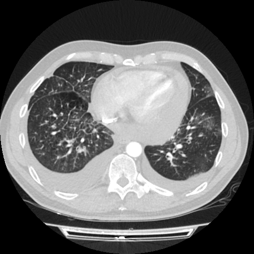 Cardiac tamponade (Radiopaedia 78607-91368 Axial lung window 63).jpg