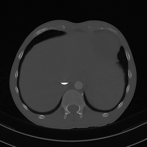 Cardiac tumor - undifferentiated pleomorphic sarcoma (Radiopaedia 45844-50134 Axial bone window 61).png