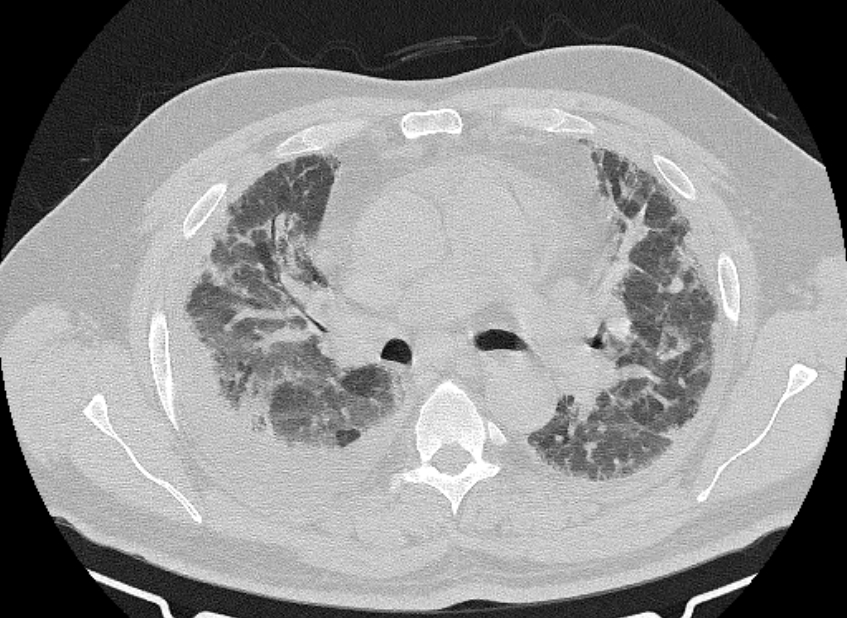 Cardiogenic pulmonary edema (Radiopaedia 68180-77678 Axial lung window 37).jpg