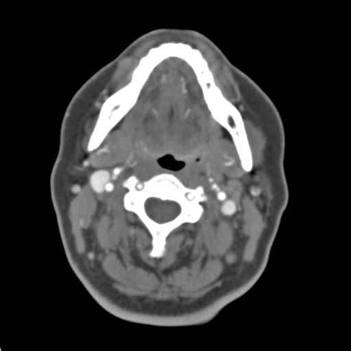 Carotico ophthalmic aneurysm (Radiopaedia 42916-46148 A 62).png