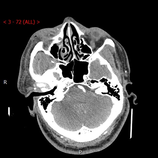 Caroticocavernous fistula (Radiopaedia 42346-45457 B 3).jpg