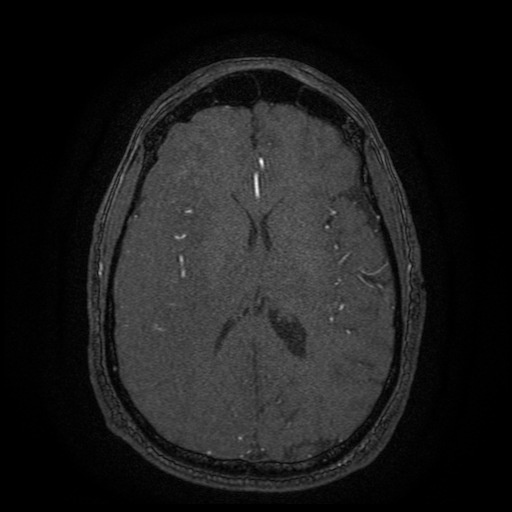 File:Carotid arterial dissection with acute cerebral infarction (Radiopaedia 26636-26784 MRA 61).jpg