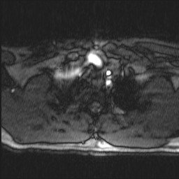 Carotid artery dissection (Radiopaedia 28441-28689 Axial MRA 6).jpg
