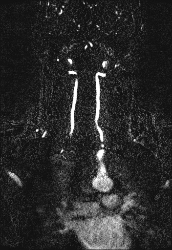 Carotid artery dissection (Radiopaedia 28441-28689 Coronal MRA 59).jpg