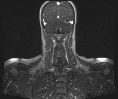 Carotid body tumor (Radiopaedia 12777-12912 MRA 63).jpg
