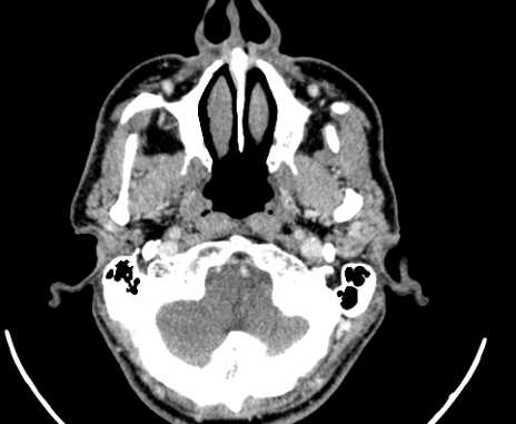 File:Carotid body tumor (Radiopaedia 61750-69757 Axial Post contrast 1).jpg