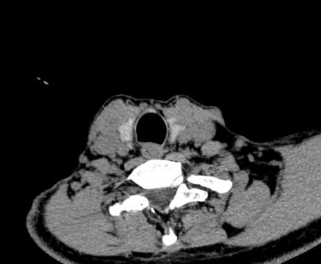 File:Carotid body tumor (Radiopaedia 61750-69757 Axial non-contrast 94).jpg