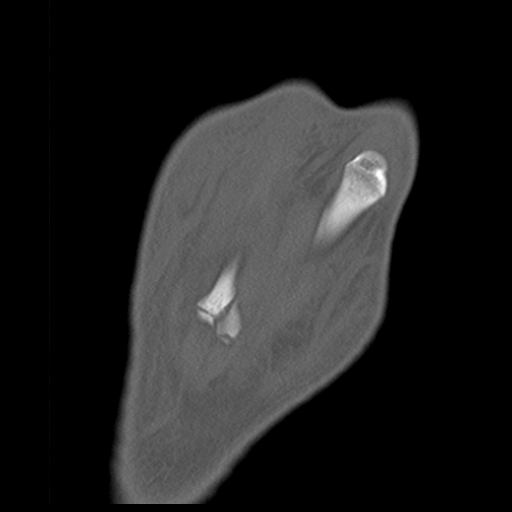 File:Carpo-metacarpal fracture-dislocations with hamatum split fracture (Radiopaedia 18482-18343 Coronal bone window 2).jpg