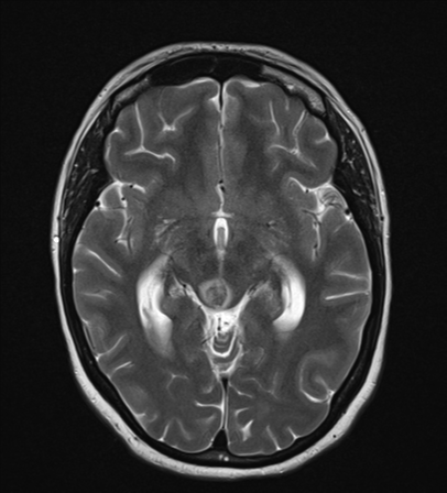 File:Cavernoma with bleed - midbrain (Radiopaedia 54546-60774 Axial T2 12).png