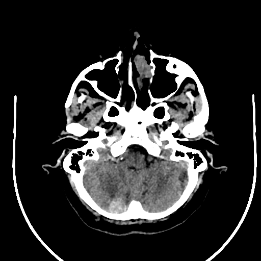 Cavernous hemangioma of the cerebellar falx (Radiopaedia 73025-83723 Axial non-contrast 22).jpg