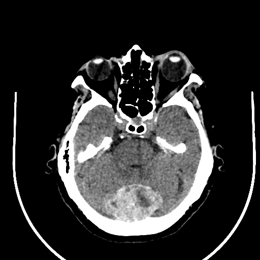 Cavernous hemangioma of the cerebellar falx (Radiopaedia 73025-83723 Axial non-contrast 41).jpg