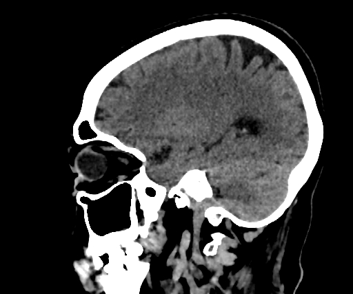 Cavernous hemangioma of the cerebellar falx (Radiopaedia 73025-83723 B 223).jpg