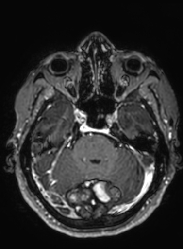Cavernous hemangioma of the cerebellar falx (Radiopaedia 73025-83724 Axial T1 C+ 238).jpg