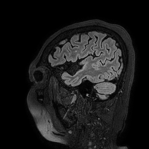Cavernous hemangioma of the cerebellar falx (Radiopaedia 73025-83724 Sagittal FLAIR 30).jpg