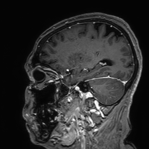 File:Cavernous hemangioma of the cerebellar falx (Radiopaedia 73025-83724 Sagittal T1 C+ 66).jpg