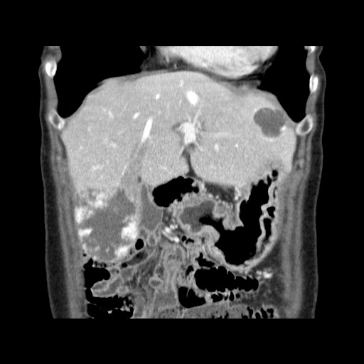 Cavernous hepatic hemangioma (Radiopaedia 75441-86667 C 40).jpg