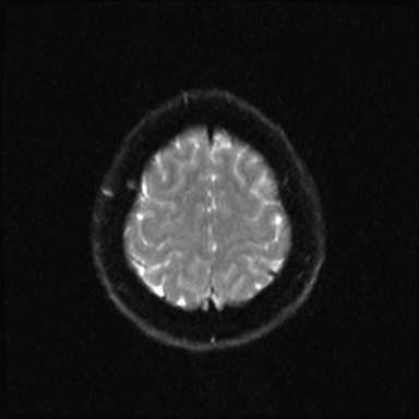 Cavernous sinus meningioma (Radiopaedia 63682-72367 DWI 19).jpg