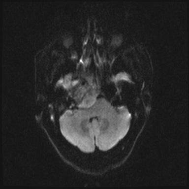 File:Cavernous sinus meningioma (Radiopaedia 63682-72367 DWI 26).jpg