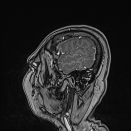 Cavernous sinus meningioma (Radiopaedia 63682-72367 Sagittal T1 C+ 37).jpg