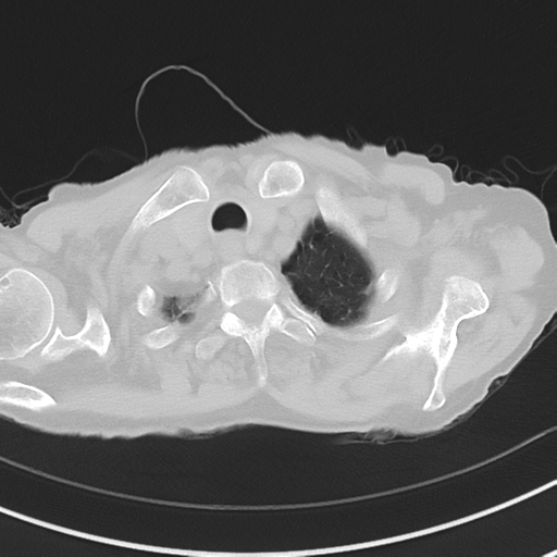 Cavitating pneumonia - lingular segments (Radiopaedia 34386-35678 Axial lung window 8).png