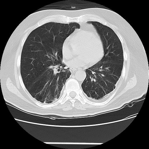 Cavitating pulmonary metastases (Radiopaedia 89545-106544 Axial lung window 35).jpg